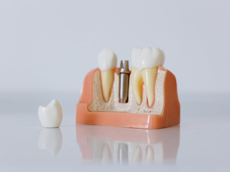 Implantes no Dia