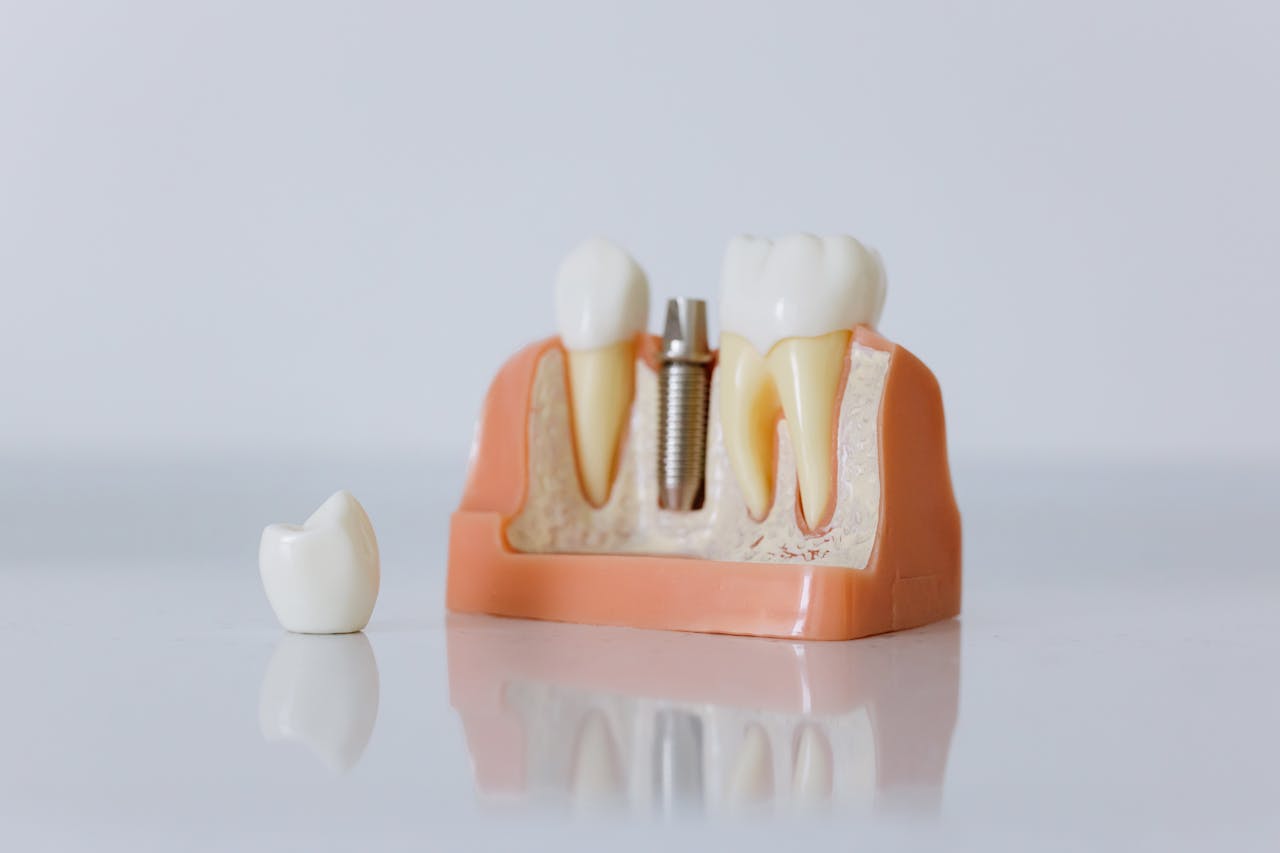 Implantes no Dia